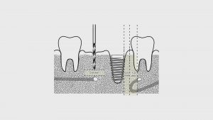 植牙知識-下顎神經-Drill-loop