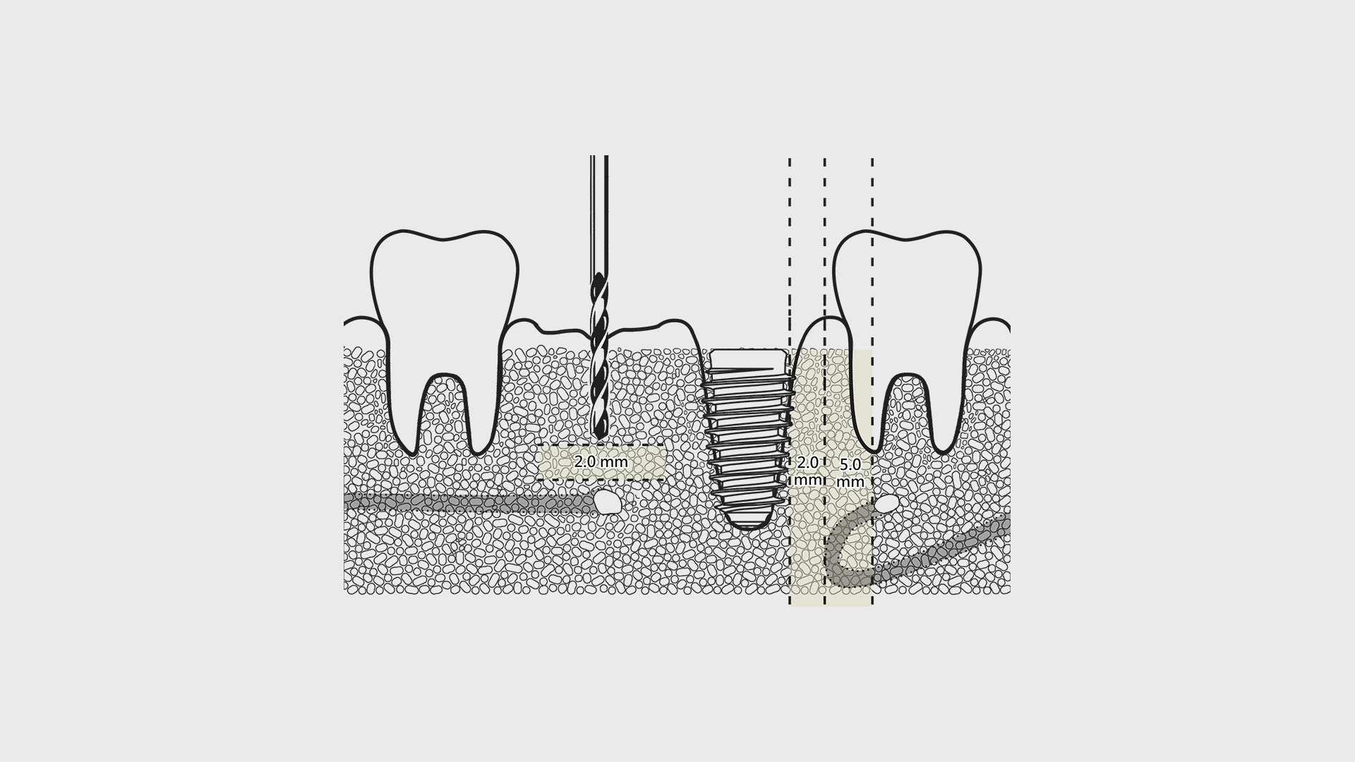 溫故方知新：牙科知識重覽 / Implant Knowledge Review
