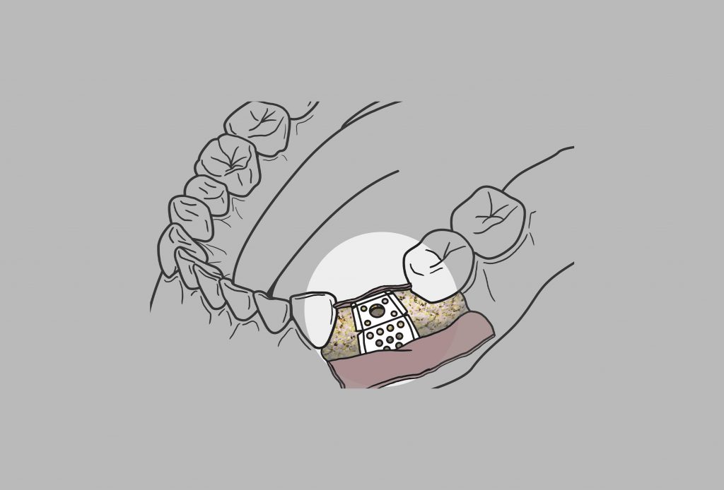 植牙術式撇步大匯集 - 置入骨粉