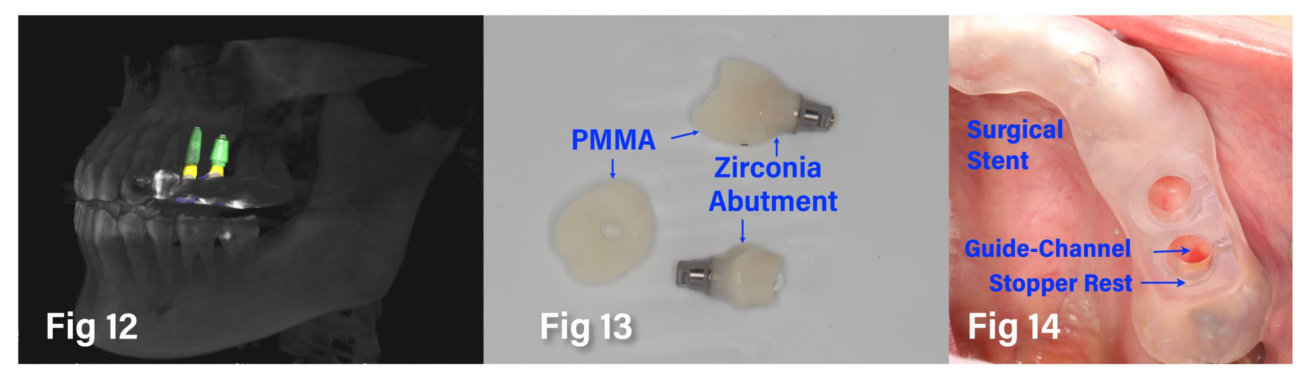 Fig.13-14 完成 Surgical Stent、Zirconia Abutment 和 PMMA Provision 製作