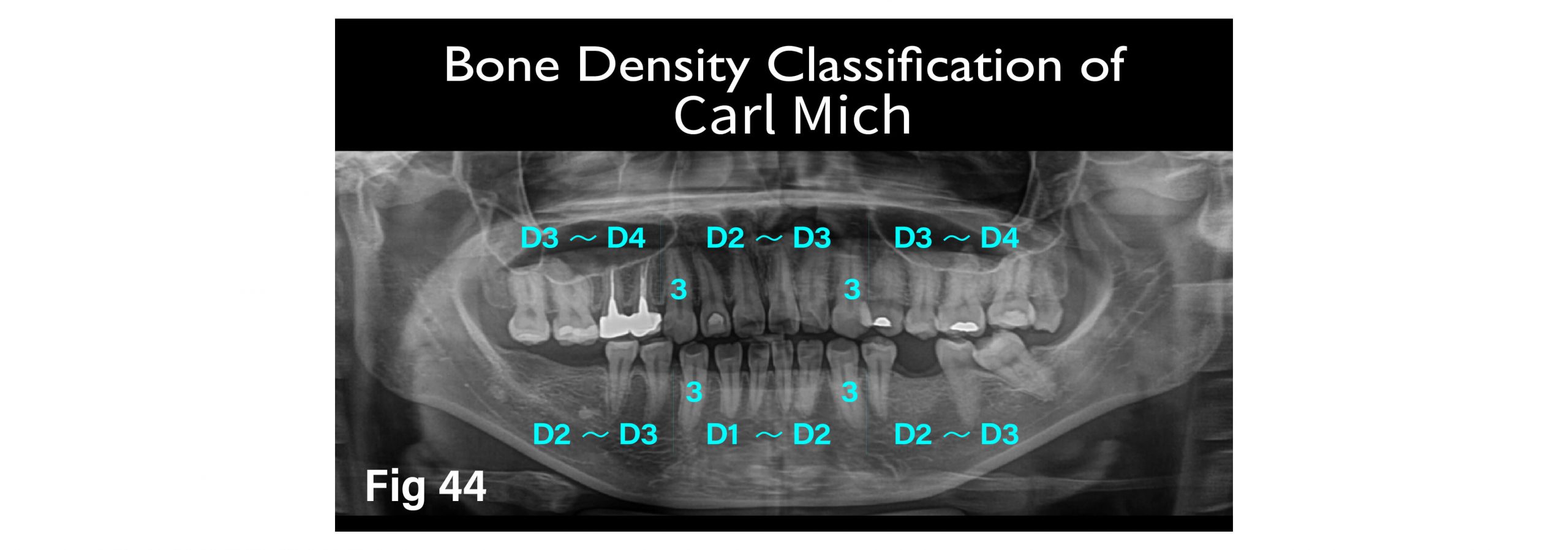Fig.44 Carl Mich "Bone Density Classification"