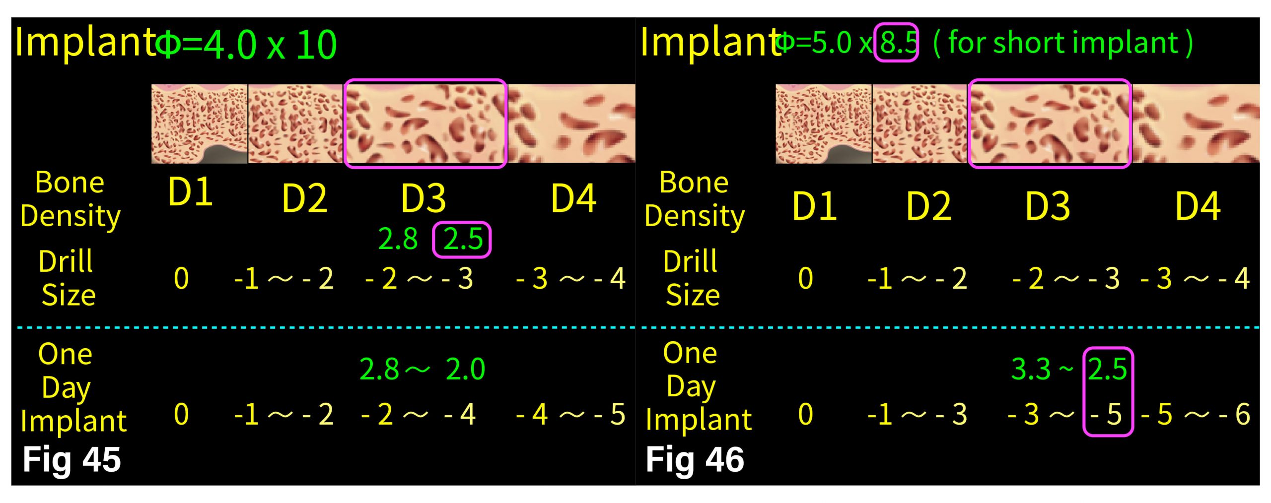 Fig.45-46 Drill 與 Bone Density 對照圖表
