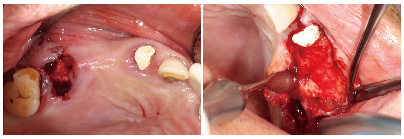 Fig.2-3 術前口內照、翻瓣檢視骨缺損情況